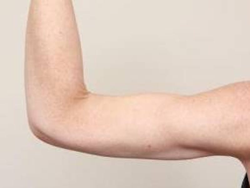 Arm Lift Before & After Gallery - Patient 350294 - Image 4 - Scott Chapin, MD