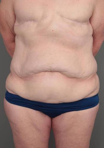 Lower Body Lift Before & After Gallery - Patient 329436 - Image 1 - Scott Chapin, MD