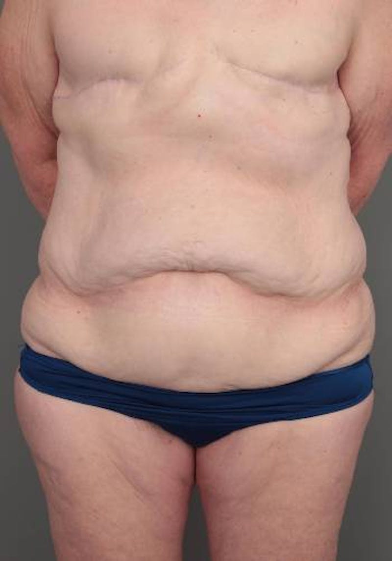 Lower Body Lift Before & After Gallery - Patient 329436 - Image 1 - Scott Chapin, MD
