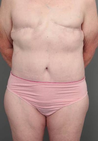 Lower Body Lift Before & After Gallery - Patient 329436 - Image 2 - Scott Chapin, MD