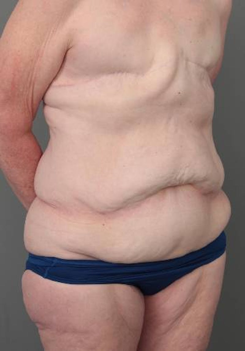 Lower Body Lift Before & After Gallery - Patient 329436 - Image 3 - Scott Chapin, MD