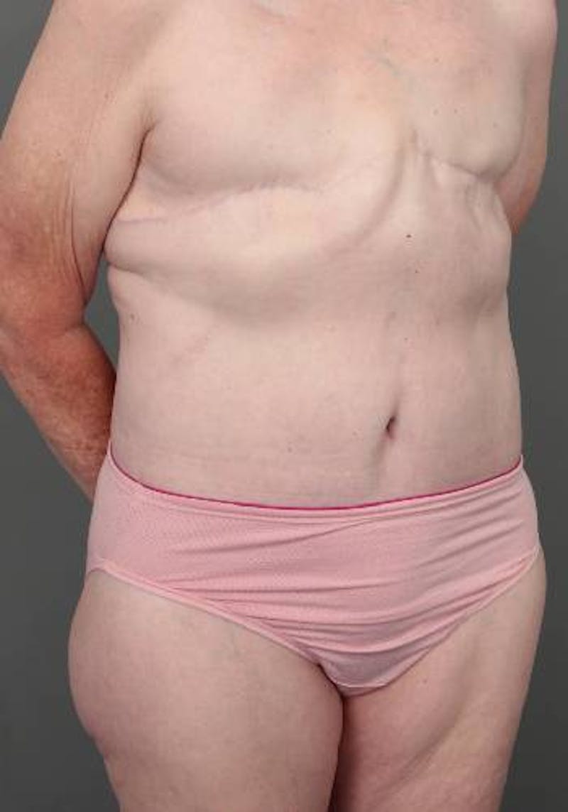 Lower Body Lift Before & After Gallery - Patient 329436 - Image 4 - Scott Chapin, MD