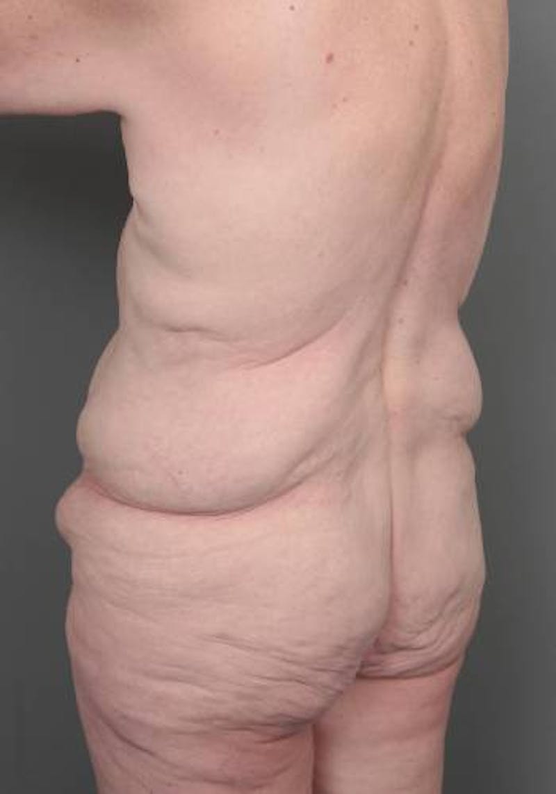 Lower Body Lift Before & After Gallery - Patient 329436 - Image 5 - Scott Chapin, MD