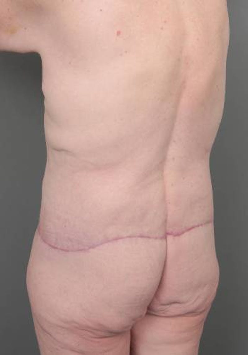 Lower Body Lift Before & After Gallery - Patient 329436 - Image 6 - Scott Chapin, MD