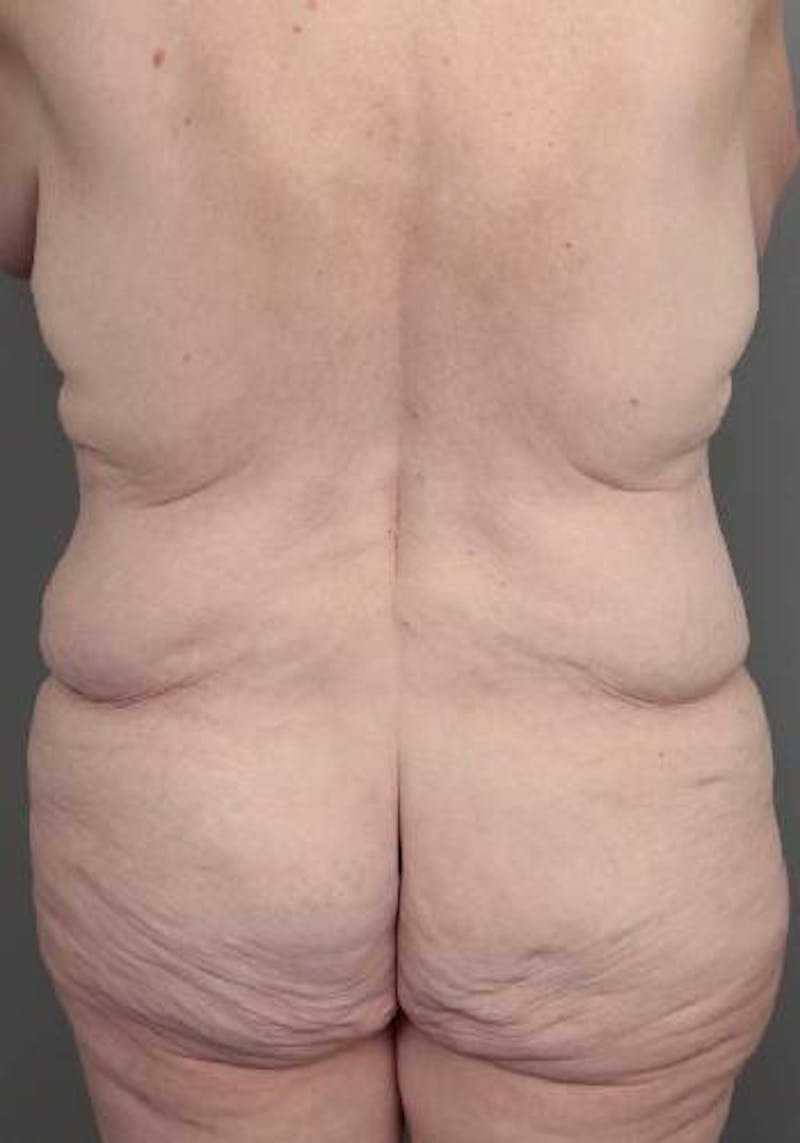 Lower Body Lift Before & After Gallery - Patient 329436 - Image 7 - Scott Chapin, MD
