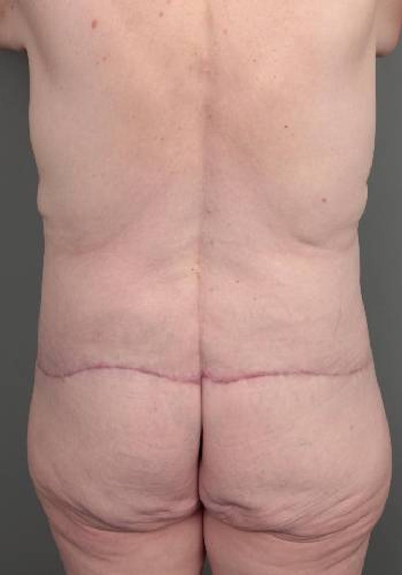 Lower Body Lift Before & After Gallery - Patient 329436 - Image 8 - Scott Chapin, MD