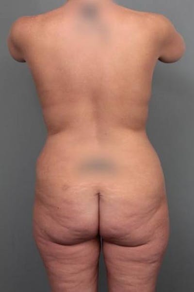 Lower Body Lift Before & After Gallery - Patient 353157 - Image 1 - Scott Chapin, MD