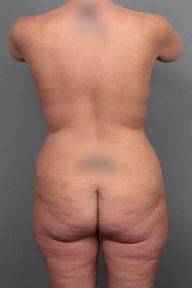 Lower Body Lift Before & After Gallery - Patient 353157 - Image 1 - Scott Chapin, MD