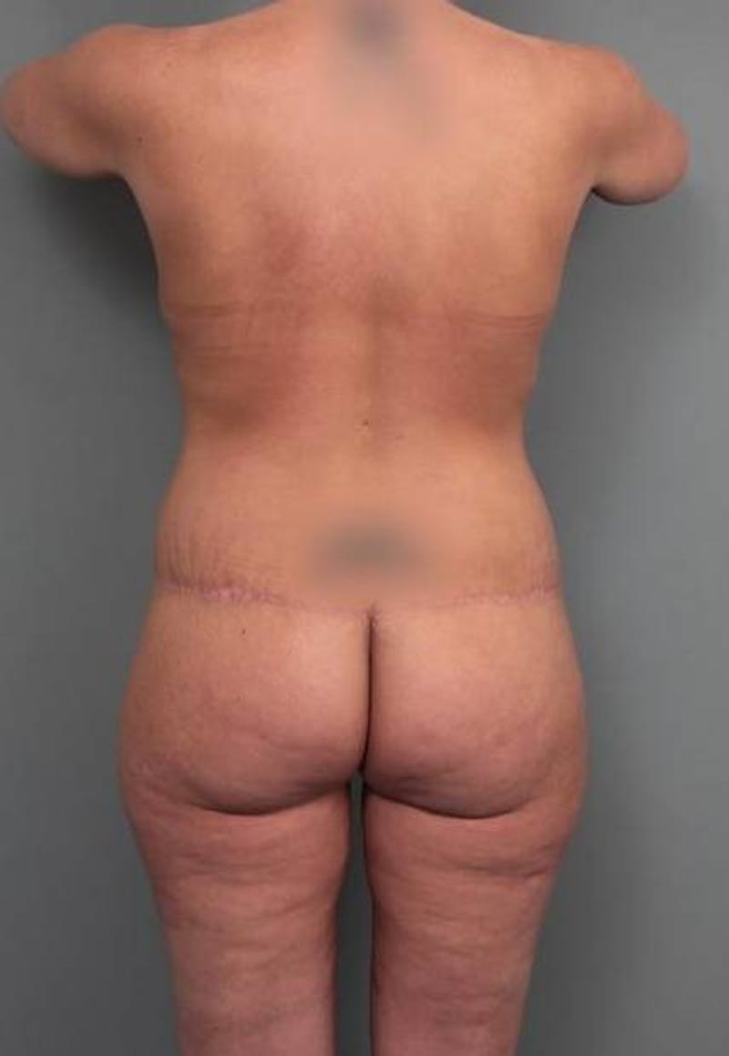 Lower Body Lift Before & After Gallery - Patient 353157 - Image 2 - Scott Chapin, MD