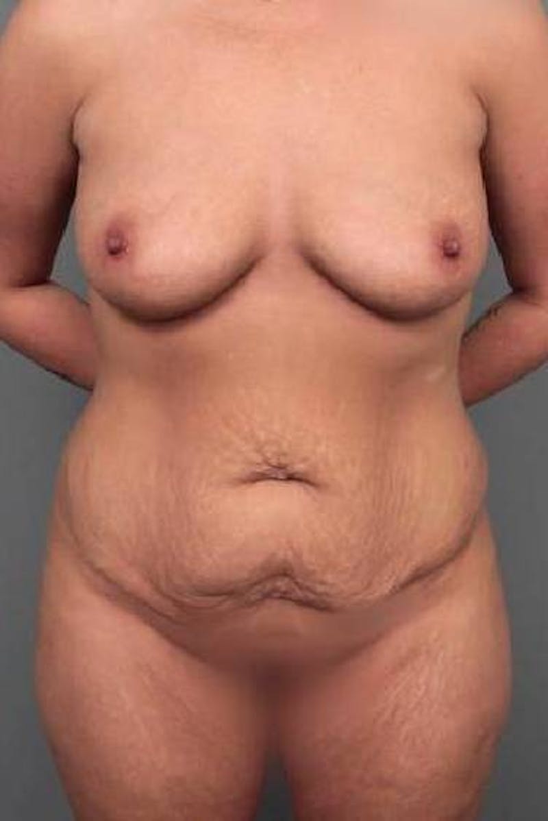 Lower Body Lift Before & After Gallery - Patient 353157 - Image 3 - Scott Chapin, MD