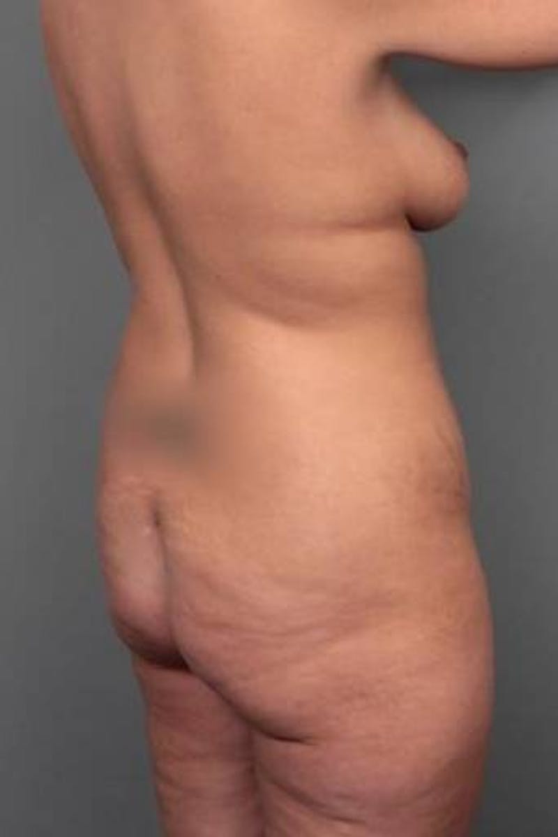 Lower Body Lift Before & After Gallery - Patient 353157 - Image 7 - Scott Chapin, MD