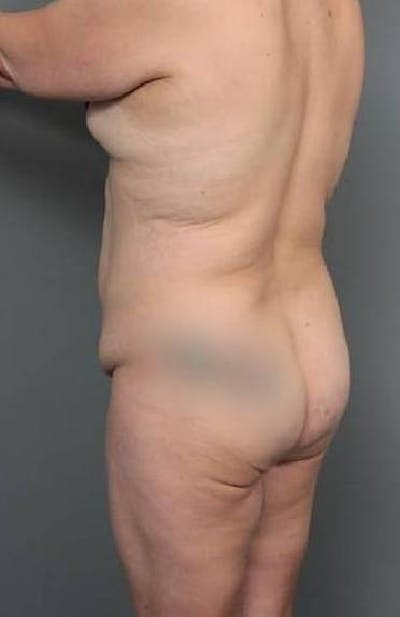 Lower Body Lift Before & After Gallery - Patient 279414 - Image 1 - Scott Chapin, MD