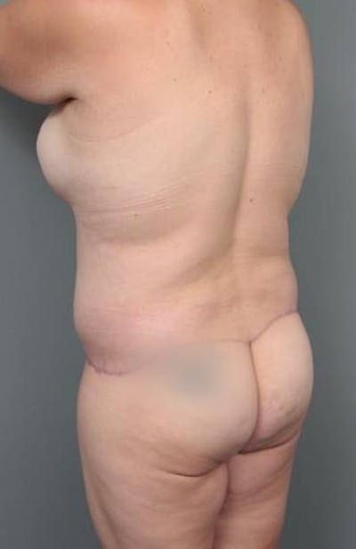 Lower Body Lift Before & After Gallery - Patient 279414 - Image 2 - Scott Chapin, MD