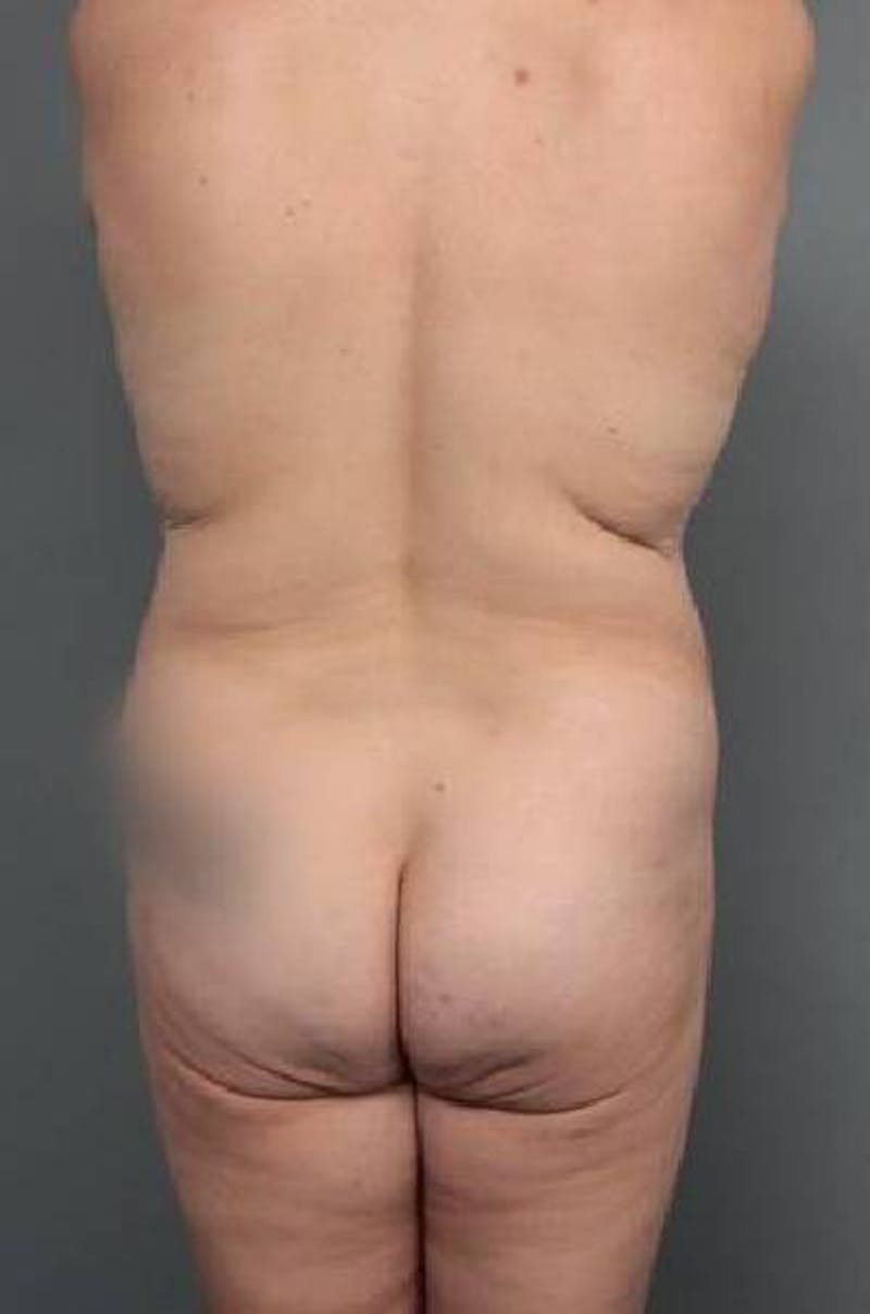 Lower Body Lift Before & After Gallery - Patient 279414 - Image 9 - Scott Chapin, MD