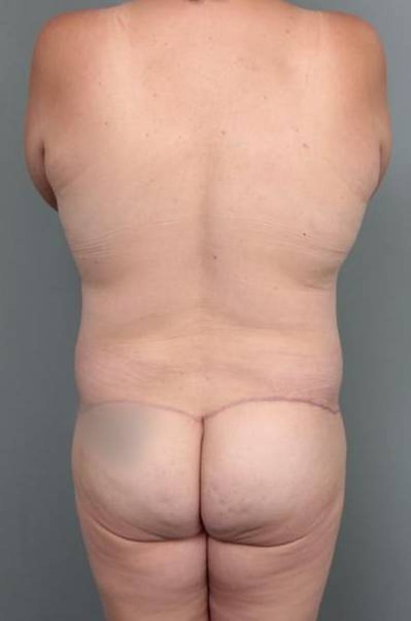 Lower Body Lift Before & After Gallery - Patient 279414 - Image 10 - Scott Chapin, MD