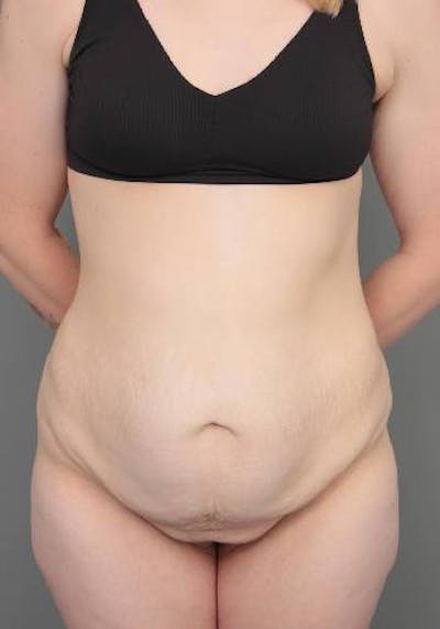Lower Body Lift Before & After Gallery - Patient 412217 - Image 1 - Scott Chapin, MD