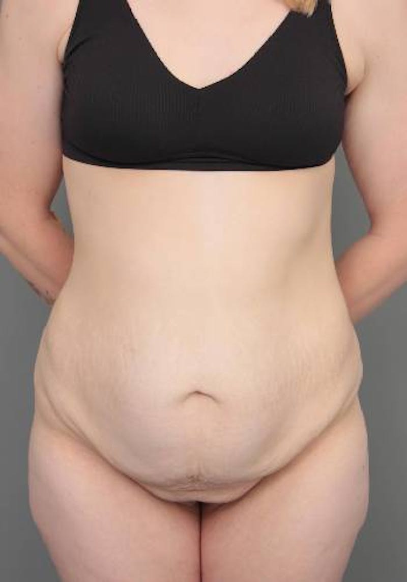 Lower Body Lift Before & After Gallery - Patient 412217 - Image 1 - Scott Chapin, MD