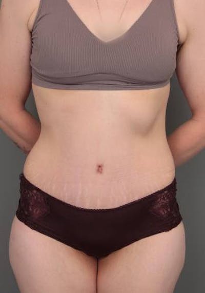 Lower Body Lift Before & After Gallery - Patient 412217 - Image 2 - Scott Chapin, MD