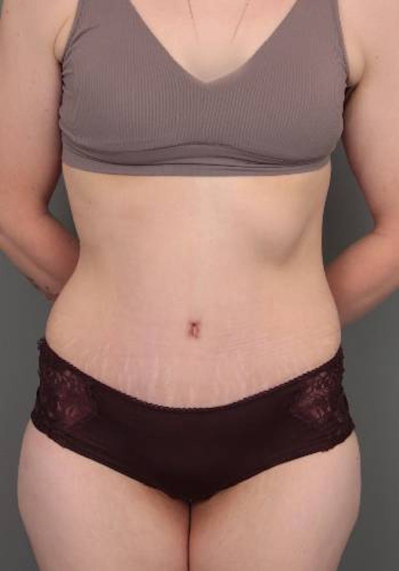 Lower Body Lift Before & After Gallery - Patient 412217 - Image 2 - Scott Chapin, MD