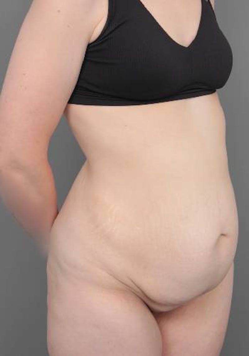 Lower Body Lift Before & After Gallery - Patient 412217 - Image 3 - Scott Chapin, MD