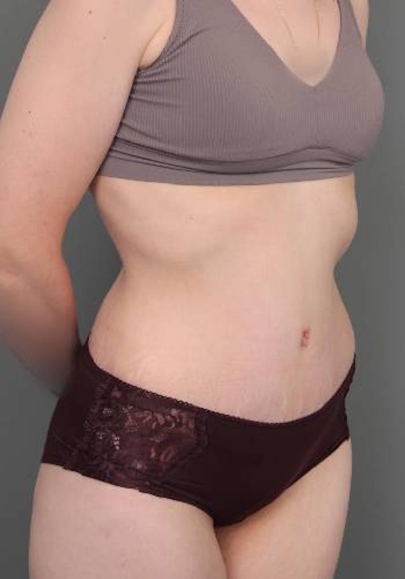 Lower Body Lift Before & After Gallery - Patient 412217 - Image 4 - Scott Chapin, MD