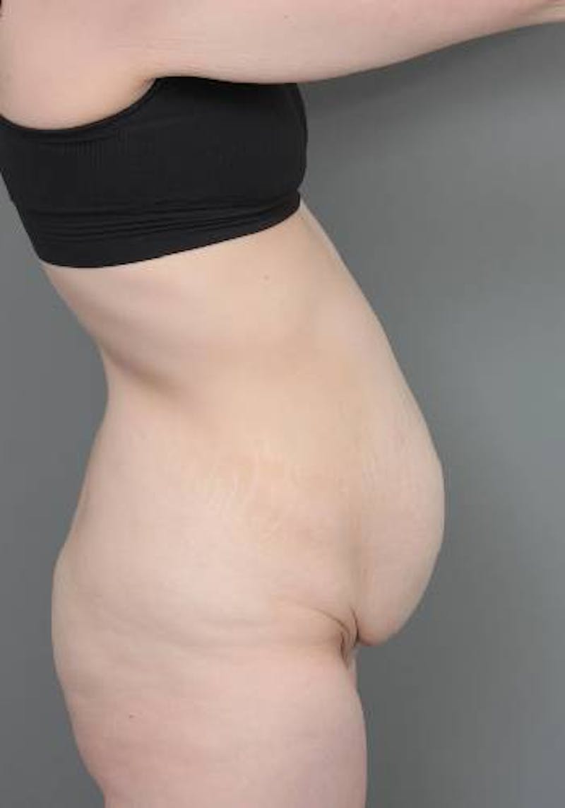 Lower Body Lift Before & After Gallery - Patient 412217 - Image 5 - Scott Chapin, MD