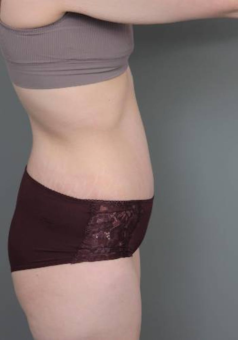 Lower Body Lift Before & After Gallery - Patient 412217 - Image 6 - Scott Chapin, MD