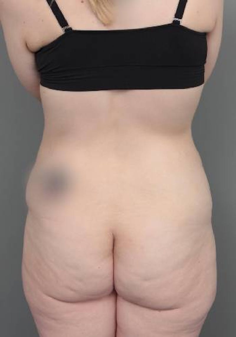 Lower Body Lift Before & After Gallery - Patient 412217 - Image 7 - Scott Chapin, MD