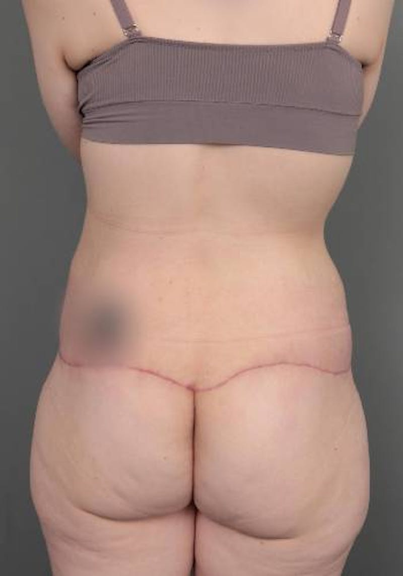 Lower Body Lift Before & After Gallery - Patient 412217 - Image 8 - Scott Chapin, MD