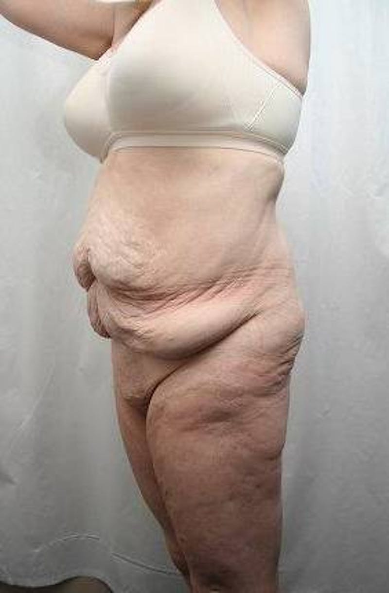 Lower Body Lift Before & After Gallery - Patient 293717 - Image 1 - Scott Chapin, MD