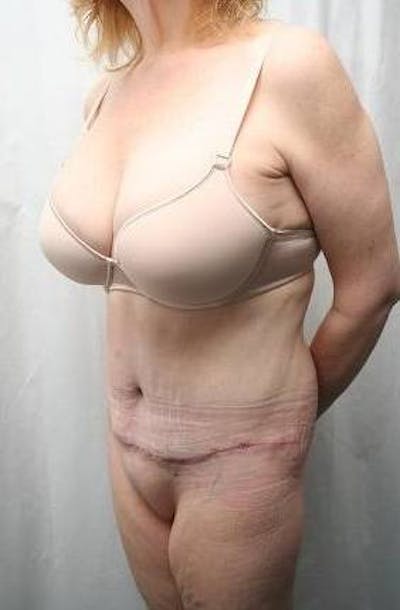Lower Body Lift Before & After Gallery - Patient 293717 - Image 2 - Scott Chapin, MD