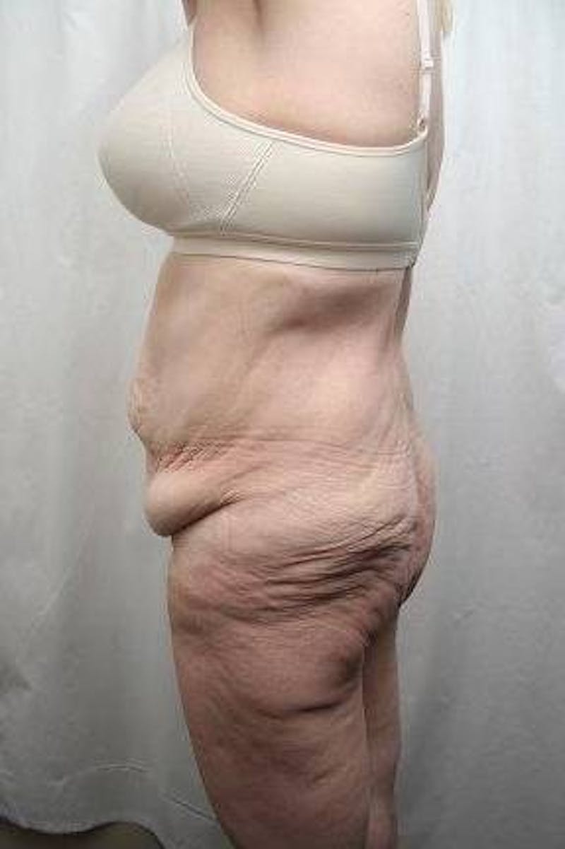 Lower Body Lift Before & After Gallery - Patient 293717 - Image 3 - Scott Chapin, MD