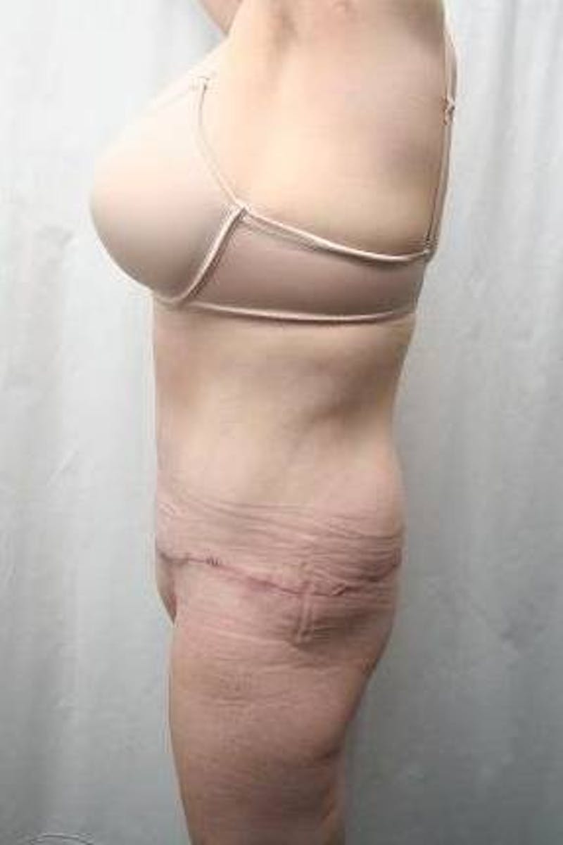 Lower Body Lift Before & After Gallery - Patient 293717 - Image 4 - Scott Chapin, MD