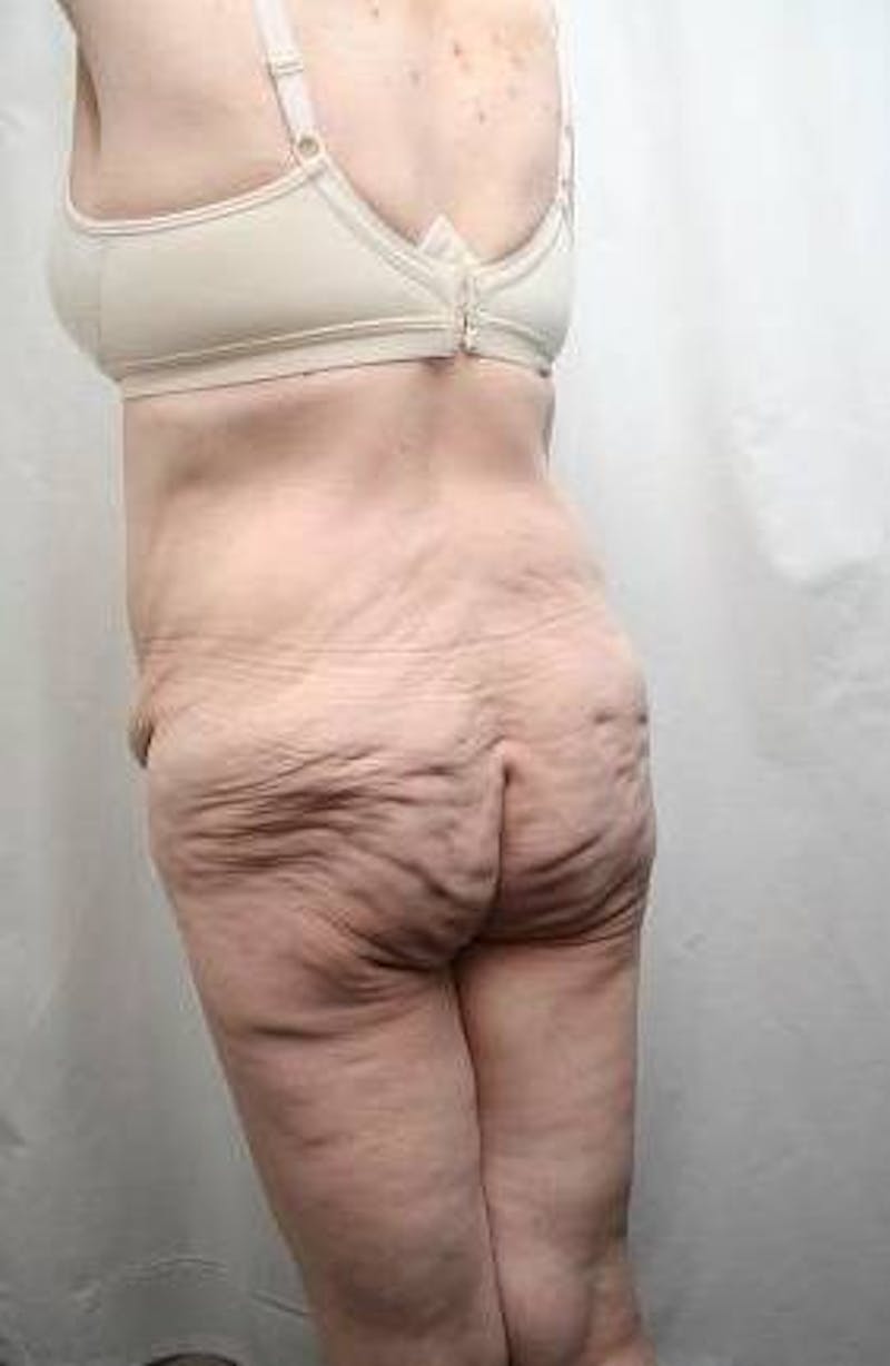 Lower Body Lift Before & After Gallery - Patient 293717 - Image 5 - Scott Chapin, MD
