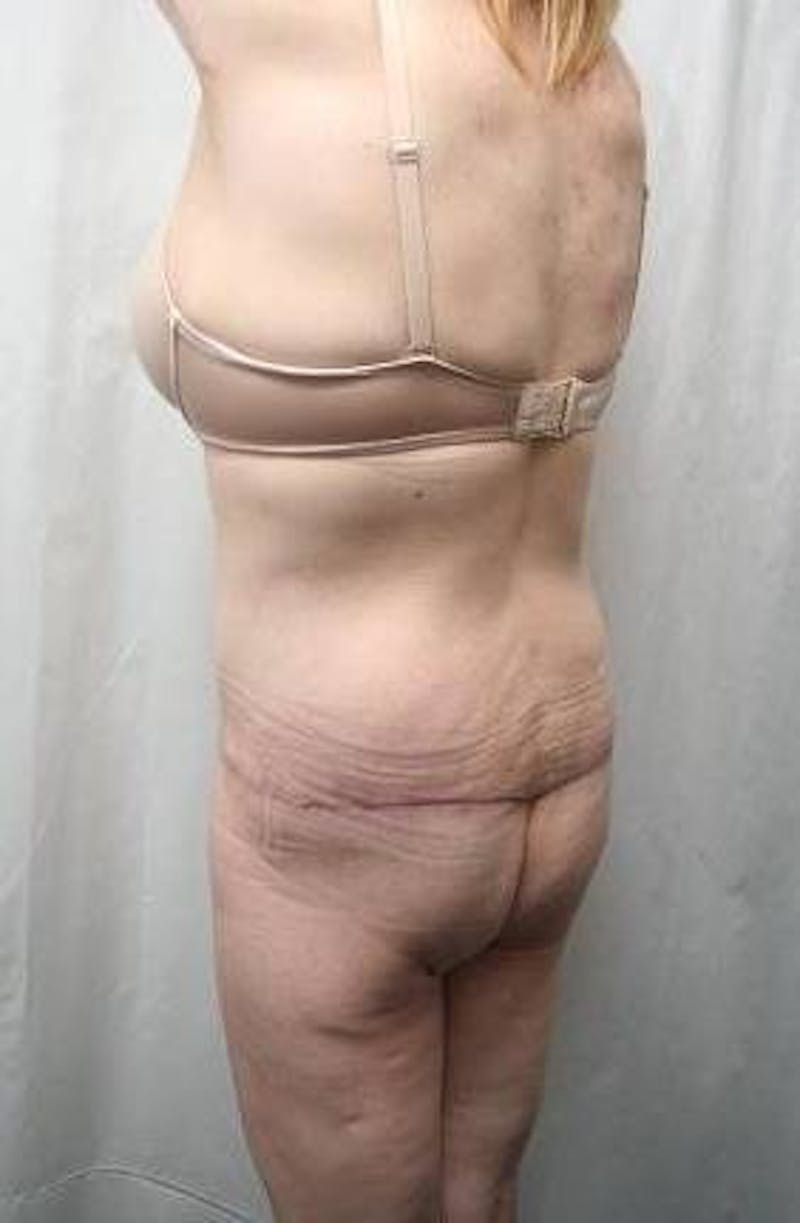 Lower Body Lift Before & After Gallery - Patient 293717 - Image 6 - Scott Chapin, MD