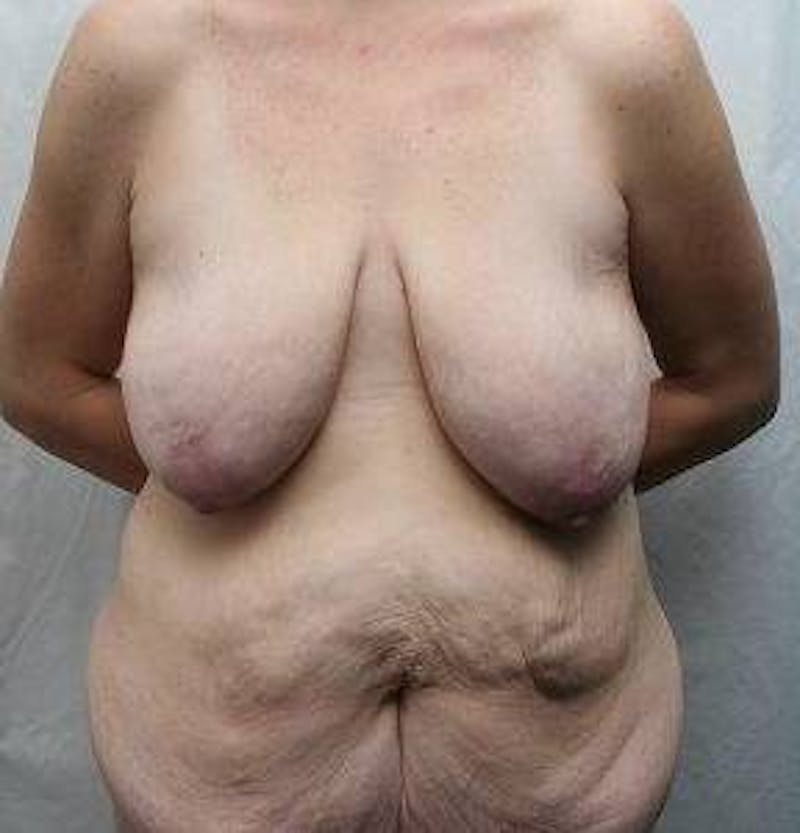 Lower Body Lift Before & After Gallery - Patient 276631 - Image 1 - Scott Chapin, MD