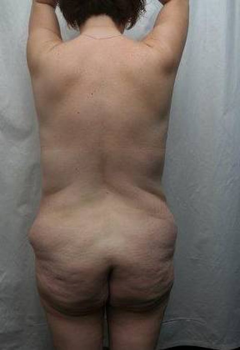 Lower Body Lift Before & After Gallery - Patient 276631 - Image 3 - Scott Chapin, MD