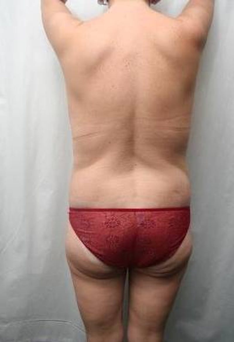 Lower Body Lift Before & After Gallery - Patient 276631 - Image 4 - Scott Chapin, MD