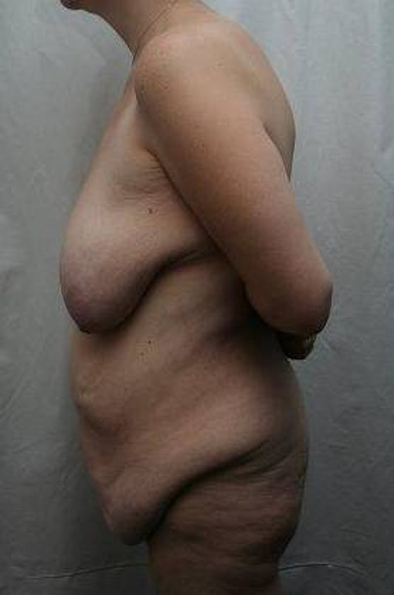 Lower Body Lift Before & After Gallery - Patient 276631 - Image 5 - Scott Chapin, MD