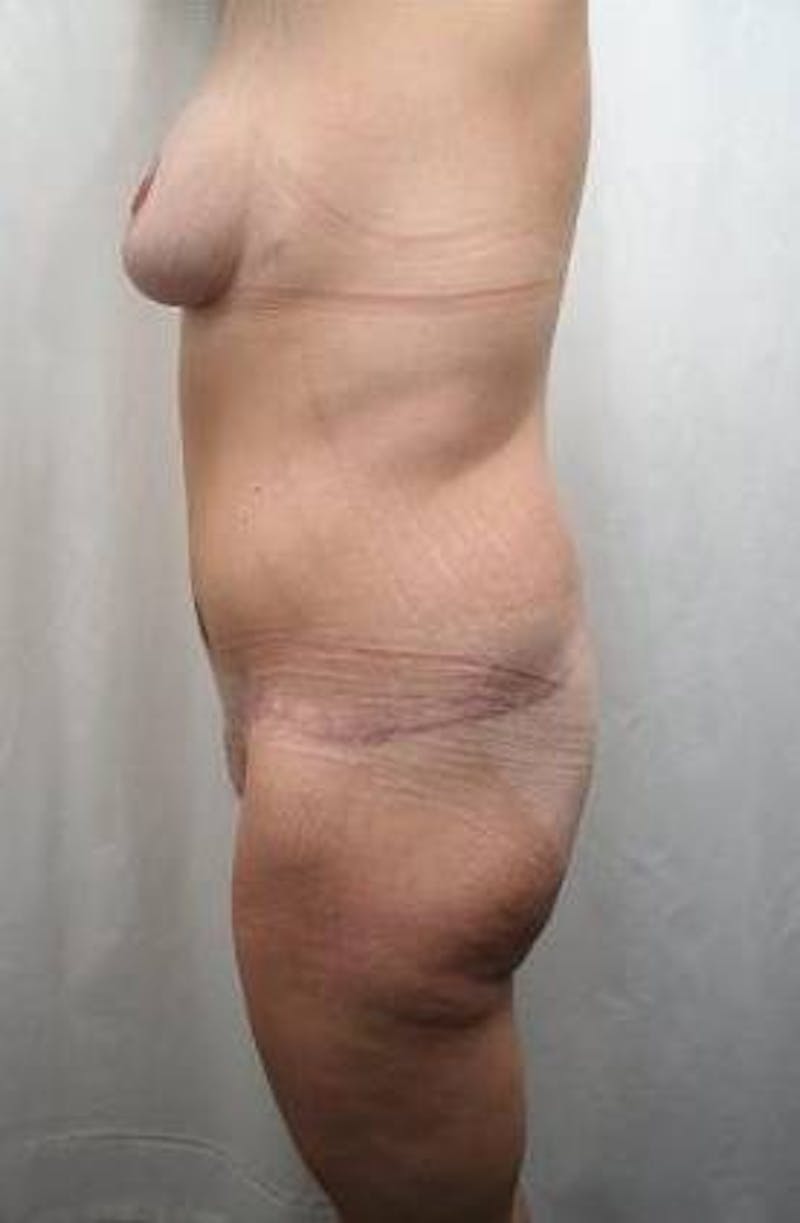 Lower Body Lift Before & After Gallery - Patient 276631 - Image 6 - Scott Chapin, MD