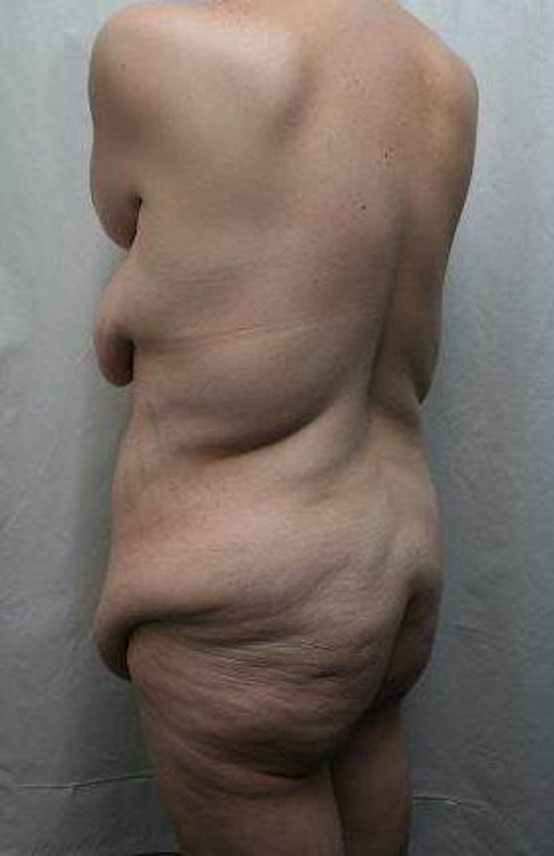 Lower Body Lift Before & After Gallery - Patient 276631 - Image 7 - Scott Chapin, MD