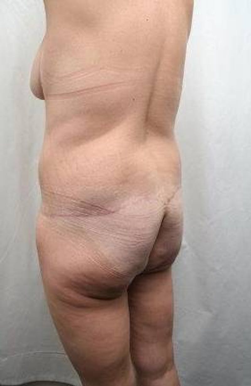 Lower Body Lift Before & After Gallery - Patient 276631 - Image 8 - Scott Chapin, MD