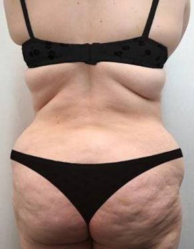 Lower Body Lift Before & After Gallery - Patient 199634 - Image 1 - Scott Chapin, MD