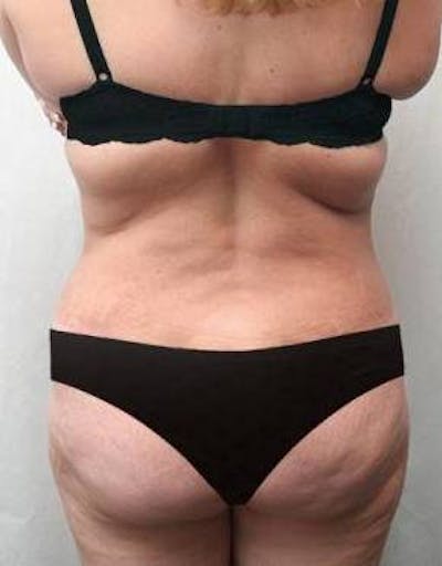 Lower Body Lift Before & After Gallery - Patient 199634 - Image 2 - Scott Chapin, MD