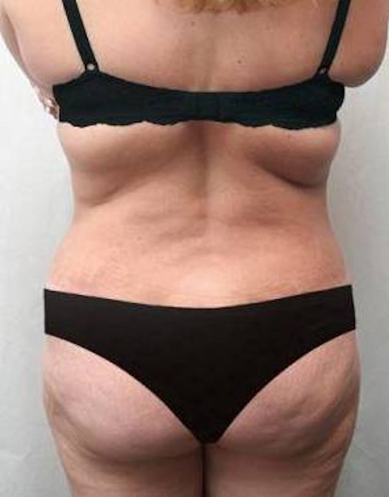 Lower Body Lift Before & After Gallery - Patient 199634 - Image 2 - Scott Chapin, MD