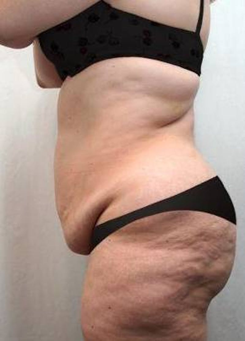 Lower Body Lift Before & After Gallery - Patient 199634 - Image 3 - Scott Chapin, MD
