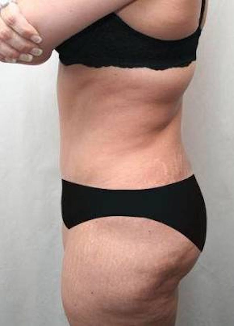 Lower Body Lift Before & After Gallery - Patient 199634 - Image 4 - Scott Chapin, MD