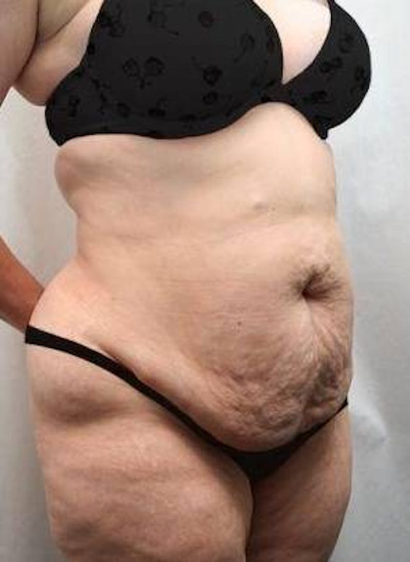 Lower Body Lift Before & After Gallery - Patient 199634 - Image 5 - Scott Chapin, MD