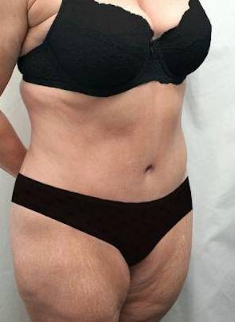 Lower Body Lift Before & After Gallery - Patient 199634 - Image 6 - Scott Chapin, MD
