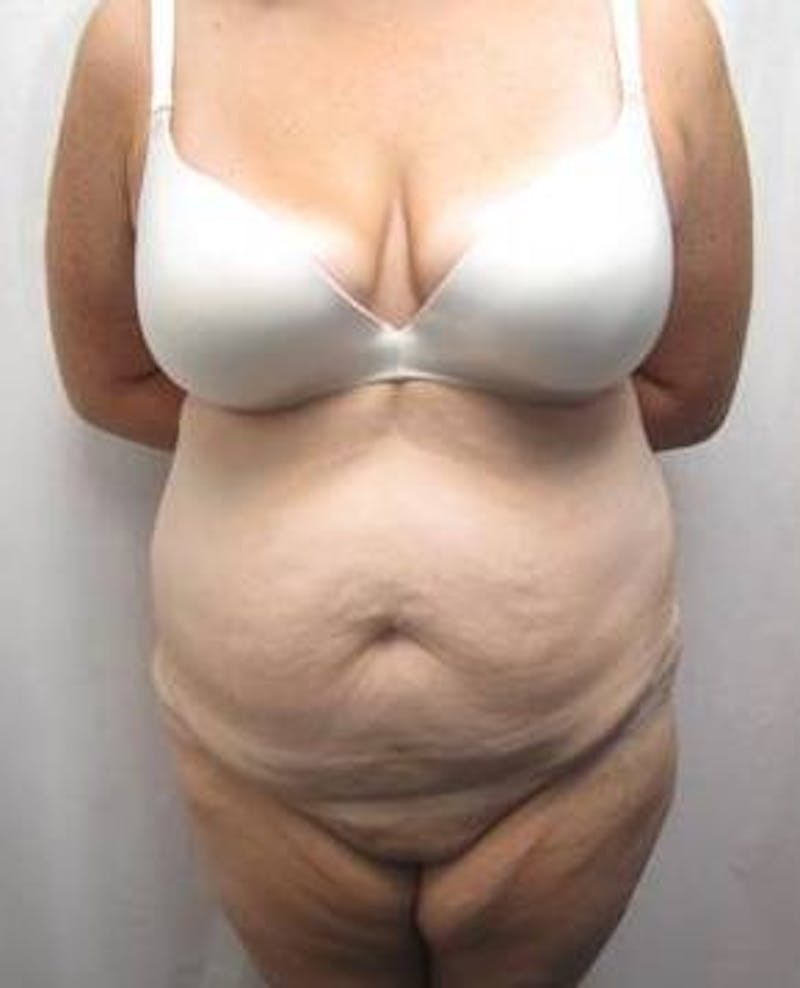 Lower Body Lift Before & After Gallery - Patient 229812 - Image 1 - Scott Chapin, MD